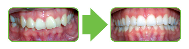 invisalign_after2