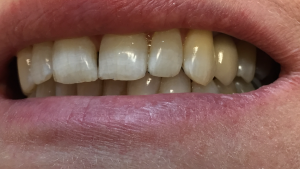 implant6-after