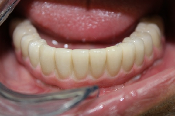 Lower Final Crowns Fixed Restoration Over Implant