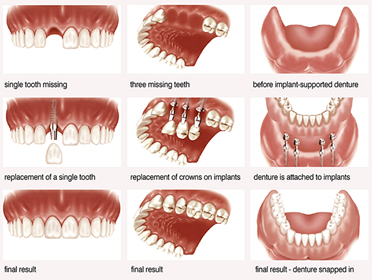 teeth-graphic
